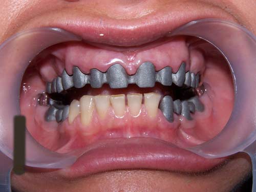 Технология протезирования зубов металлокерамикой стоматология пушкина томск 56 1