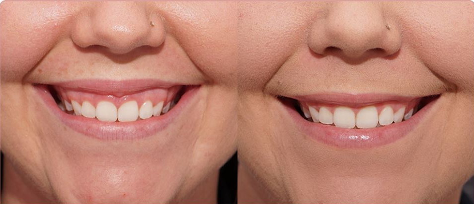 Что такое реплантация зуба: этапы и осложнения